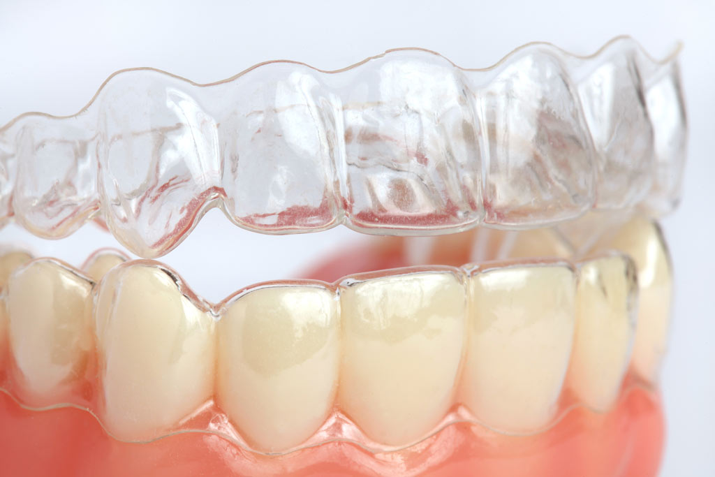 clear-dental-aligners-invisalign-removable-braces