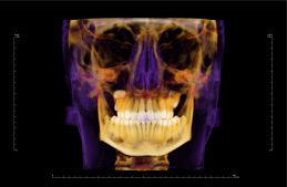 ap-super-ceph-soft-bone-2-default